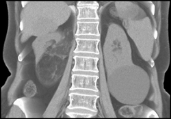 Renal Angiomyolipoma (AML) on Right - CTisus CT Scan