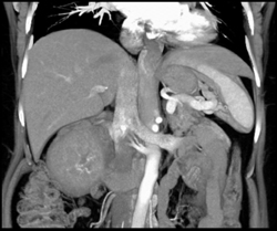 Vascular Renal Cell Carcinoma (RCC) - CTisus CT Scan