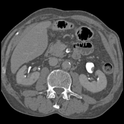 Transitional Cell Cancer (TCC) Renal Pelvis - CTisus CT Scan