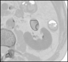 Tumor in Left Renal Pelvis - CTisus CT Scan