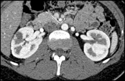 Acute Pyelonephritis - CTisus CT Scan