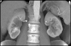 Av Fistulae of Kidney - CTisus CT Scan