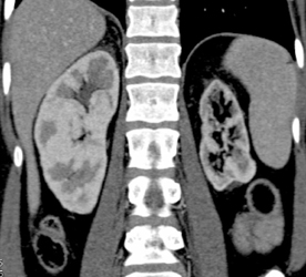 Chronic Pyelonephritis on the Left - CTisus CT Scan