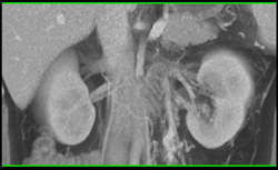 Chronic Renal Vein Thrombosis - CTisus CT Scan