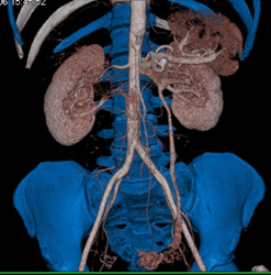 Enlarged Gonadal Vein - CTisus CT Scan