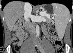 5-11 Need New Diagnoses-replaced in Book and on Cd - CTisus CT Scan