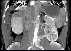 3 Left Renal Arteries Using MIP and VRT - CTisus CT Scan