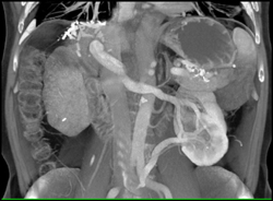 Renal Vein Arises Off Left Iliac Vein - CTisus CT Scan