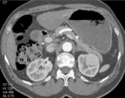 Vascular Renal Cell Carcinoma - CTisus CT Scan