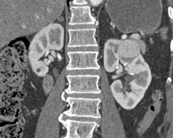 Vascular Renal Cell Carcinoma - CTisus CT Scan