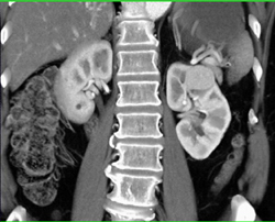 Vascular Renal Cell Carcinoma - CTisus CT Scan