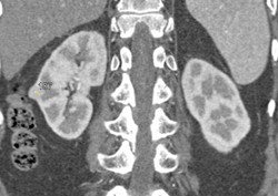 Vascular Renal Cell Carcinoma - CTisus CT Scan