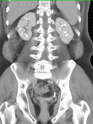 Vascular Renal Cell Carcinoma - CTisus CT Scan