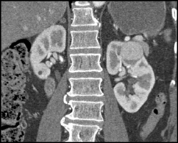 Vascular Renal Cell Carcinoma - CTisus CT Scan