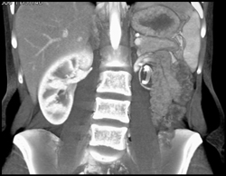 Ureteropelvic Junction (UPJ) With Crossing Vessel - CTisus CT Scan