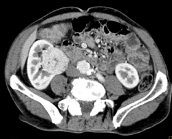 Renal Cell Carcinoma - CTisus CT Scan