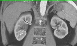 Renal Av Fistulae - CTisus CT Scan