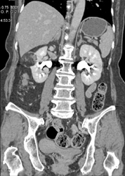 Renal Angiomyolipoma (AML) - CTisus CT Scan