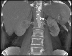 Patent Stent in the Left Renal Artery - CTisus CT Scan