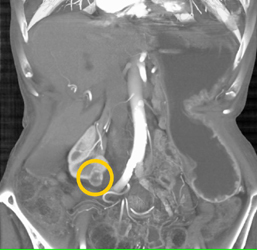 1 Cm Renal Cell Carcinoma - CTisus CT Scan