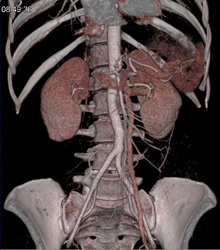 Prominent Left Gonadal Vein - CTisus CT Scan