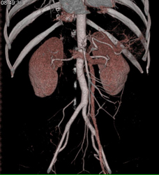 Prominent Left Gonadal Vein - CTisus CT Scan