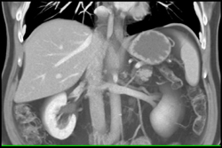 Left Gonadal Vein - CTisus CT Scan