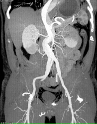 Aortic Dissection With Perfusion Changes in Both Kidneys Due to 2 Renal Arteries on Each Kidney - CTisus CT Scan