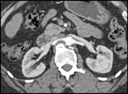 Dissection of Right Renal Artery - CTisus CT Scan