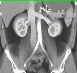 Left Renal Vein - CTisus CT Scan