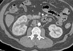 Delayed Function of the Right Kidney With Stranding Around the Right Kidney - CTisus CT Scan