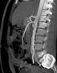 Normal Right Renal Vein - CTisus CT Scan