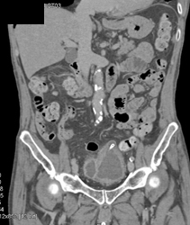 Bladder Cancer With Diverticulum - CTisus CT Scan