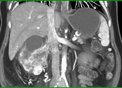 Renal Cell Carcinoma With Collaterals Around the Kidney - CTisus CT Scan