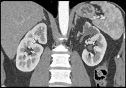 Obstructed Upper Tract on the Left With Thinning of the Cortex - CTisus CT Scan