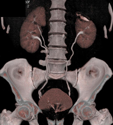 Duplication of the Right Collecting System - CTisus CT Scan