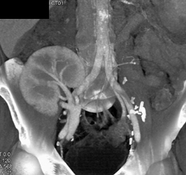 Transplant Kidney With Patent Anastomosis of Normal Function - CTisus CT Scan