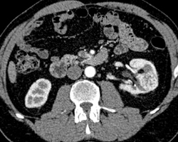 Renal Cell Carcinoma - CTisus CT Scan