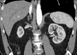 Renal Cell Carcinoma - CTisus CT Scan