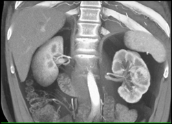 Renal Cell Carcinoma - CTisus CT Scan