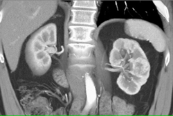 Renal Cell Carcinoma - CTisus CT Scan