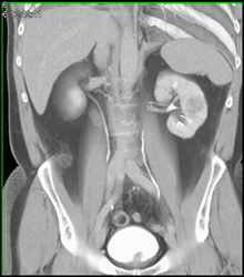 Renal Cell Carcinoma - CTisus CT Scan