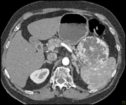 Vascular Renal Cell Carcinoma Invading the Left Renal Vein - CTisus CT Scan