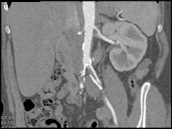 Occlusion of the Right Renal Artery - CTisus CT Scan