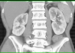 Acute Pyelonephritis - CTisus CT Scan