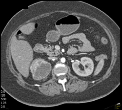 Renal Cell Carcinoma - CTisus CT Scan