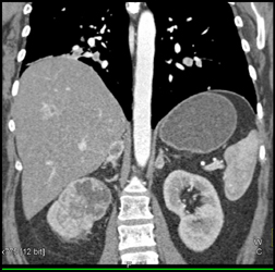 Renal Cell Carcinoma - CTisus CT Scan