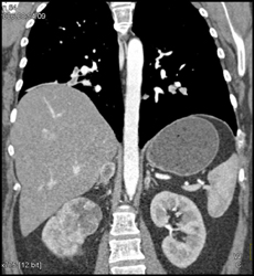 Renal Cell Carcinoma - CTisus CT Scan