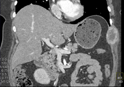 Renal Cell Carcinoma - CTisus CT Scan