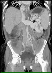 Spleno-renal Shunting Due to Portal Hypertension - CTisus CT Scan